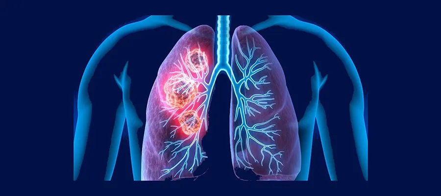 Does COPD Balloon Treatment Work?