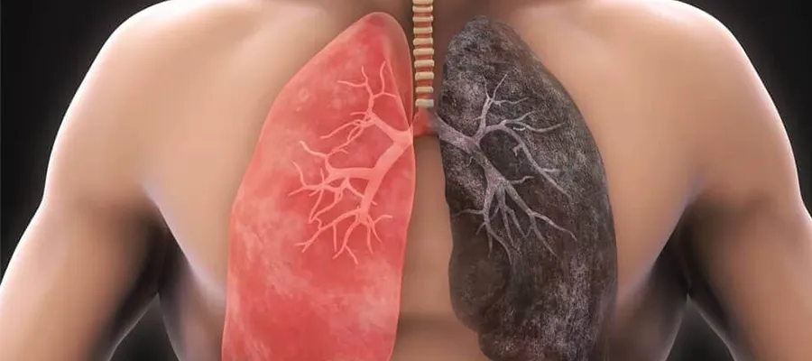 What Kind of Disease is COPD?